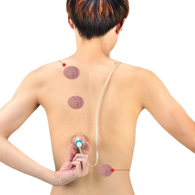 🔥 Hot sale 30% OFF🔥Thickened Vacuum Cupping Set with Suction Pump